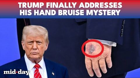 Trump BIG BRUISE Goes Viral: Suspicious Reason REVEALED in Davos | WATCH