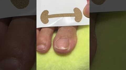 Relief made simple!These correction patches help reduce pain from ingrown toenails#viral#trending