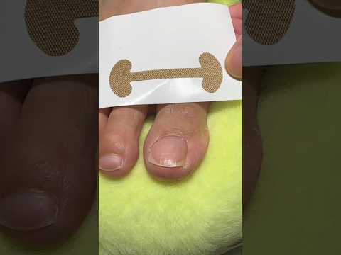 Relief made simple!These correction patches help reduce pain from ingrown toenails#viral#trending