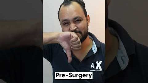 Hair Transplant Surgery Experience | Latest Fue Technique #shorts #viral #hair transplant