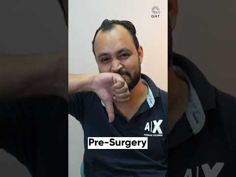 Hair Transplant Surgery Experience | Latest Fue Technique #shorts #viral #hair transplant