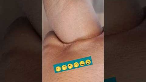 Cannulation.. video.. part 359 #shorts #viral #trending #2023
