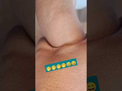 Cannulation.. video.. part 359 #shorts #viral #trending #2023