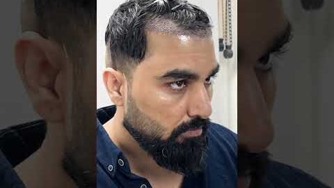 Bigg Boss Fame Armaan Malik Hair Transplant Journey #shorts #viral #hairtransplant