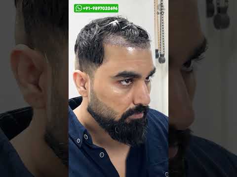 Bigg Boss Fame Armaan Malik Hair Transplant Journey #shorts #viral #hairtransplant