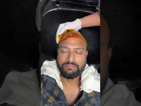 Best Hair Transplant Surgery | Latest Fue Technique #shorts #viral #hair transplant