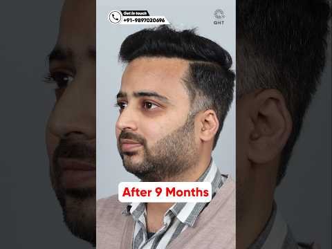 Nine Months Hair Transplant Results | Latest Fue Technique #shorts #viral #hair transplant