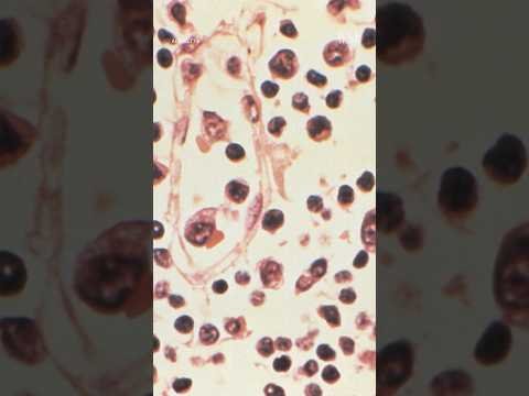 How Dangerous Is Hantavirus?