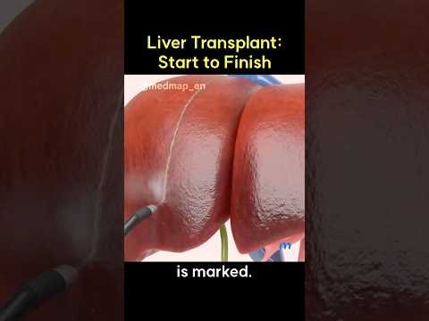 Liver Transplant: Start to Finish