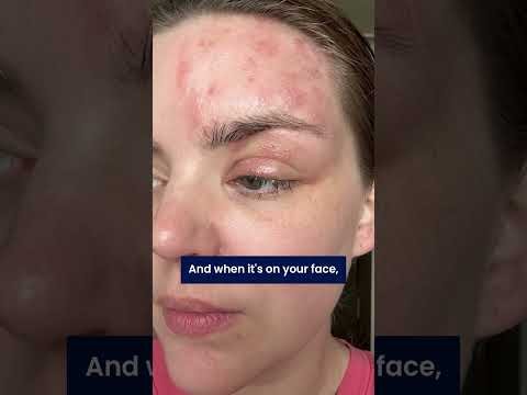 Reporter shares painful shingles journey to warn others at risk