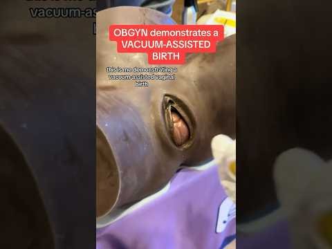 #OBGYN shows vacuum-assisted #birth. #shorts